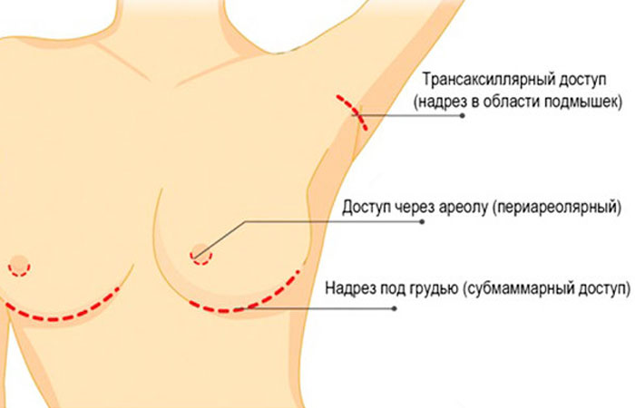 Как в Турции проводят операции по увеличению груди 
